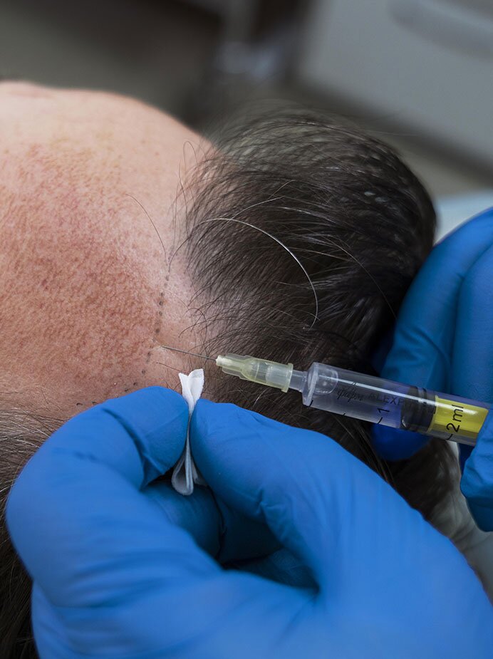 home-prp-hair-treatment-img1-the-cosmetic-club-2023