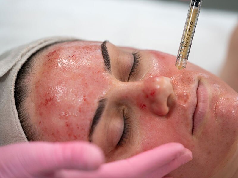 vampire-facial-skin-treatment-img1-the-cosmetic-club-2023