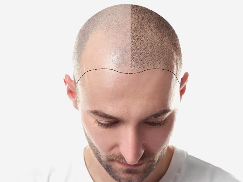 hair-transplant-hair-treatment-img1-the-cosmetic-club-2023